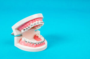 青い背景の前に置かれたワイヤー矯正の歯科模型