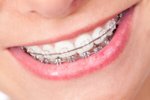 ワイヤー矯正の装置をつけた歯を見せて笑う女性