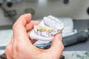 歯のブリッジを作成する歯科技工士
