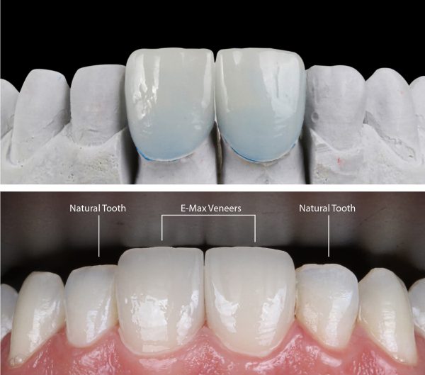 前歯をセラミックにする前後のイメージ